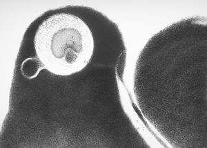 M,49y. | blood - dyserythropoetic anemia